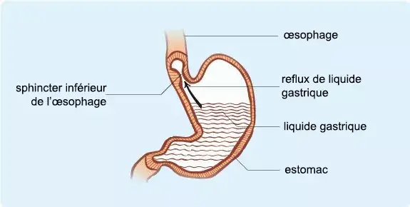 Reflux gastro oesophagien adulte el jpg